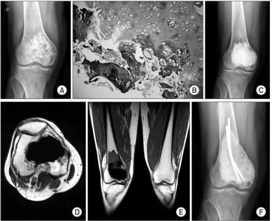 Figure 2. (A) Initial plain radiograph  of a 51-year-old man (Case 8) shows  mixed osteolytic and sclerotic lesion with  calcifications in distal epi-metaphysis of  right femur