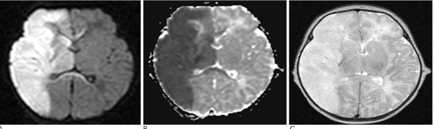 Fig. 2. The MRA using a time of flight sequence shows nonvi- nonvi-sualization of right internal carotid artery (solid arrows)  and right middle cerebral artery (arrowheads)