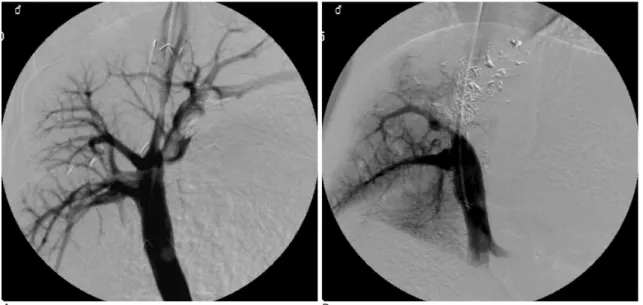Fig. 2. Follow-up portograms taken 2 weeks after the TIPS procedure.