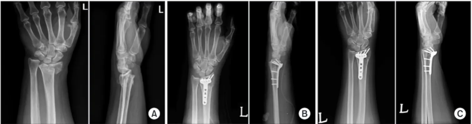 Figure 1. (A) Anteroposterior and lateral radiographs of wrist in a 70-year-old female (AO C2 type fracture)