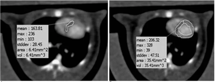 Fig. 2. Method of measuring volume ratio of infarct (A) and total myocardium (B) at mid ventricle level.