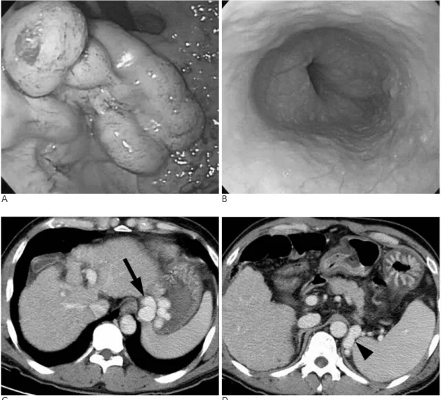 Fig. 1. A 57-year-old man with gastric variceal bleeding. 
