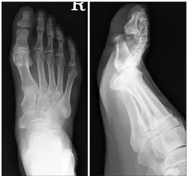 Figure 4. Immediate postoperative radiographs show reduced inter- inter-phalangeal joint of the great toe.