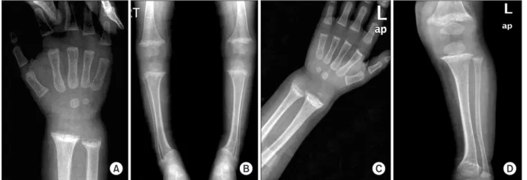 Figure 1. 17 month-old male, (A) wrist showed irregular shadow and widening of epiphyseal plate, “cupping”, bony shadow of periosteum was found,  and also similar lesion was found both right and left