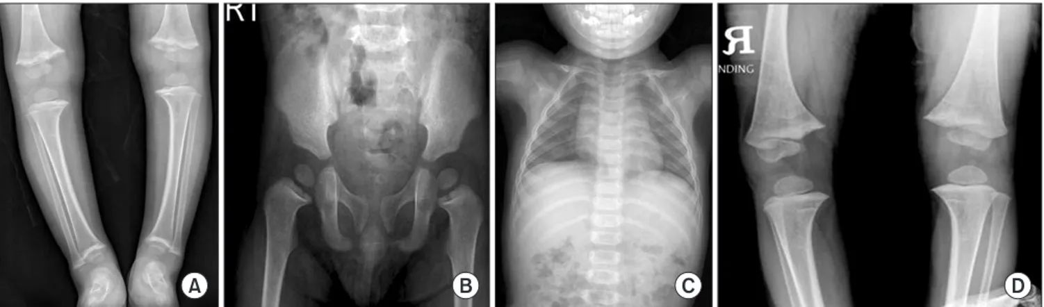 Figure 3. 18 month-old female. (A) Showing genu varum, and also  conventional radiologic findings of rickets of distal femur, proximal tibia,  and distal tibia
