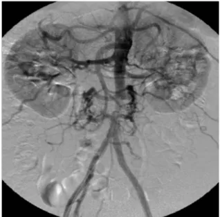 Fig. 1. A-D. The abdominal CT images reveal multiple intimal flaps and septations, which caused stenotic changes of the infra-re- infra-re-nal abdomiinfra-re-nal aorta