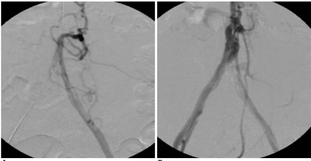 Fig. 4. Two 8 mm-8 cm Zilver stents were inserted into the stenotic portion of the infra-renal abdominal aorta with using the “kissing” technique, and post-stent ballooning was  per-formed simultaneously with using a 6 mm balloon and a 4 cm balloon