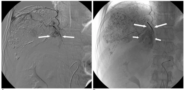 Fig. 3. (A) Selective right phrenic artery angiogram shows tumor staining (arrows) at the right adrenal gland