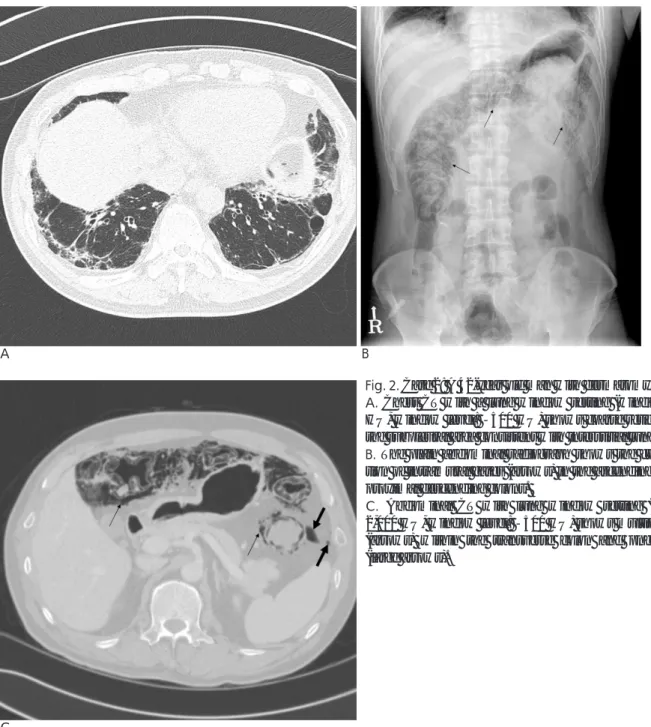 Fig. 2. Case 2: A 42-year old man with dermatomyositis. 