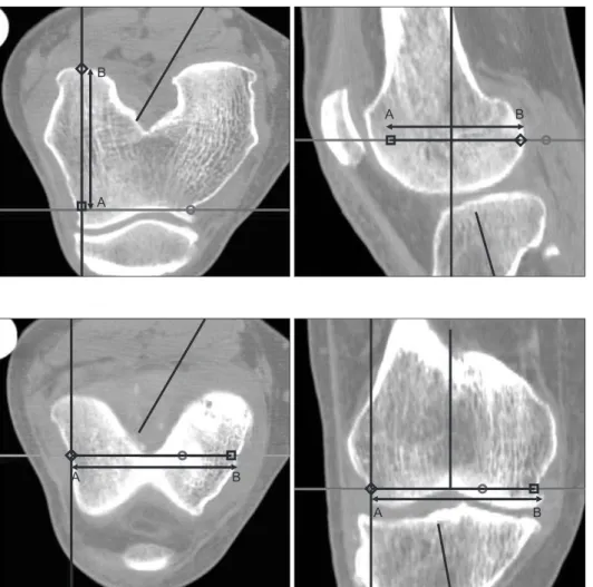 Figure 1. Measurement of the antero- antero-posterior length of lateral femoral condyle,  length of line AB and anteroposterior  distance from anterior diaphyseal cortex  to most posterior point of lateral femoral  condyle.