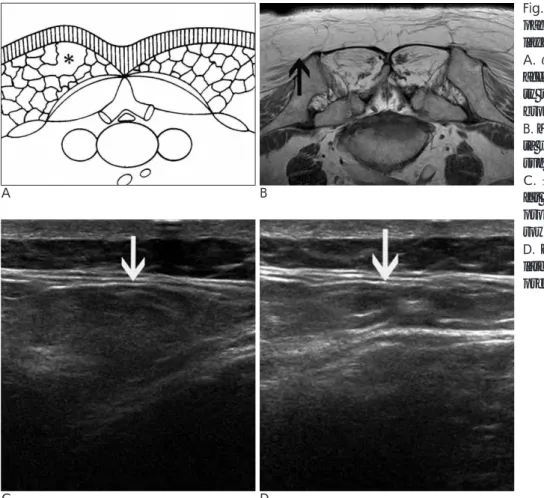 Fig. 2. A 74-year-old female with a pal- pal-pable mass at the subcutaneous fatty layer of the left lower back.