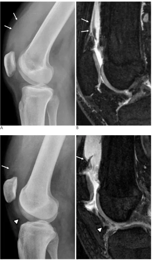 Fig. 3. Joint effusion and synovial hy- hy-pertrophy of the knee joint.