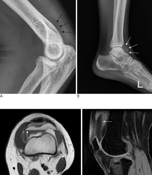 Fig. 4. Joint effusion of the elbow and ankle joint.