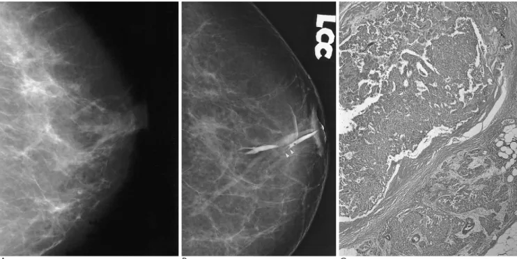 Fig. 2. A. Craniocaudal mammogram obtained 4 moths later shows complete disappearances of the microcalcifications without newly devloped lesion in the left breast