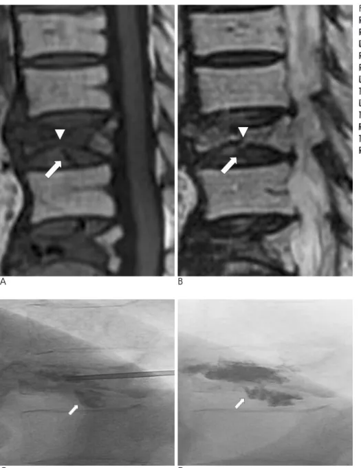 Fig. 1. A 64-year-old female had under- under-gone vertebroplasty of T11 and L1 body due to acute compression  frac-tures
