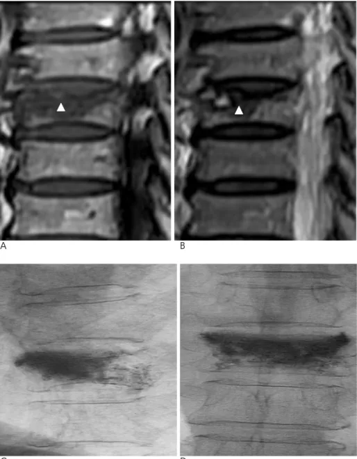 Fig. 2. A 78-year-old female who had undergone vertebroplasty of T9 body due to acute compression fracture