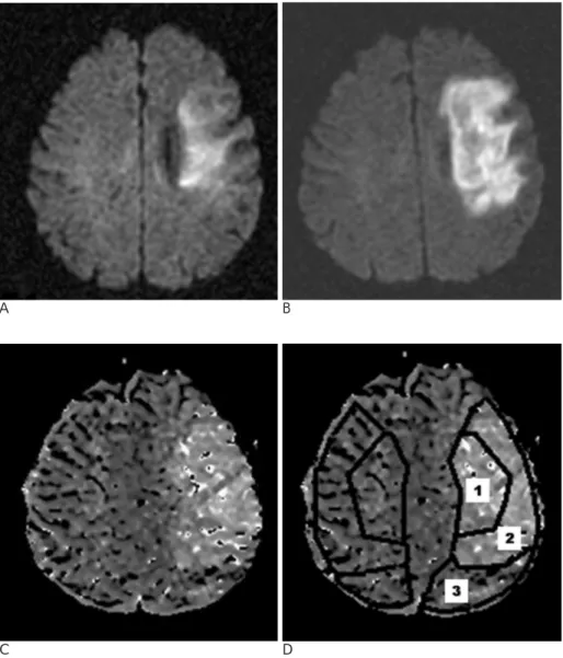 Fig. 1. A 40-year-old man with a right- right-sided weakness. Initial MR images were obtained at 4.8 hours from the onset of stroke.