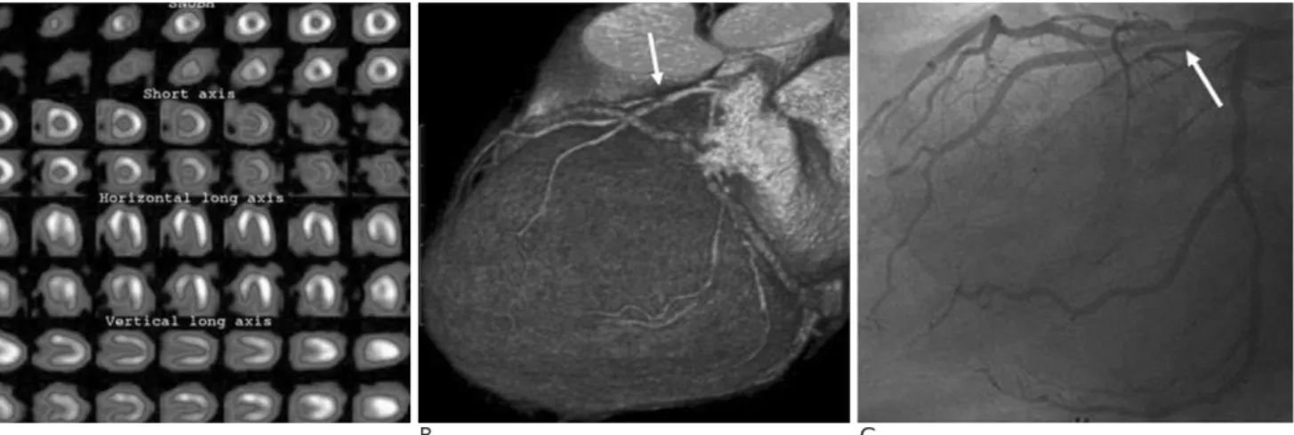 Fig. 5. A 72-year-old woman with dyspnea during two months. A. SPECT (single positron emission CT) shows normal finding