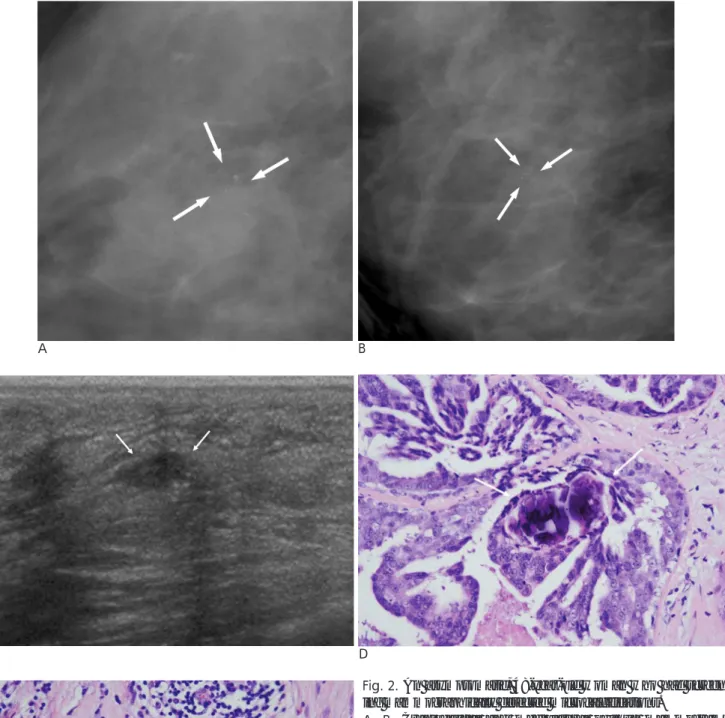Fig. 2. An asymptomatic, 48-year-old woman who had screen- screen-ing mammographically detected microcalcifications.