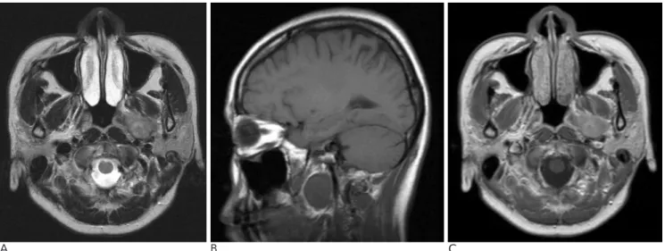 Fig. 2. A, B. A contrast-enhanced axial (A) and coronal (B) CT scan show 3×2