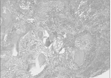 Figure  2. The  microscopic  finding  shows  chronic  osteomyelitis  associated with necrotic bone with empty lacunae and infiltration of  numerous inflammatory cells (hematoxylin-eosin stain, original  mag-nification ×100).
