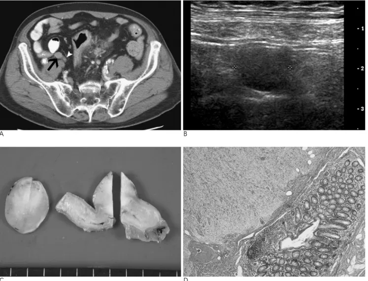 Fig. 1. 62-year-old man with appendiceal leiomyoma