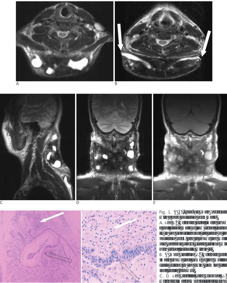 Fig. 1. A 37-year-old man presented with a hard posterior neck mass. 