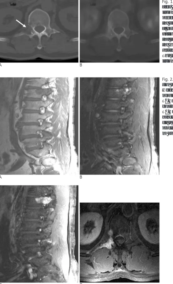 Fig. 2. MRI images (A- -D). (A) The le- le-sion shows intermediate signals on  T1-weighted images and (B)  heteroge-neously mixed high and low signal on T2-weighted images