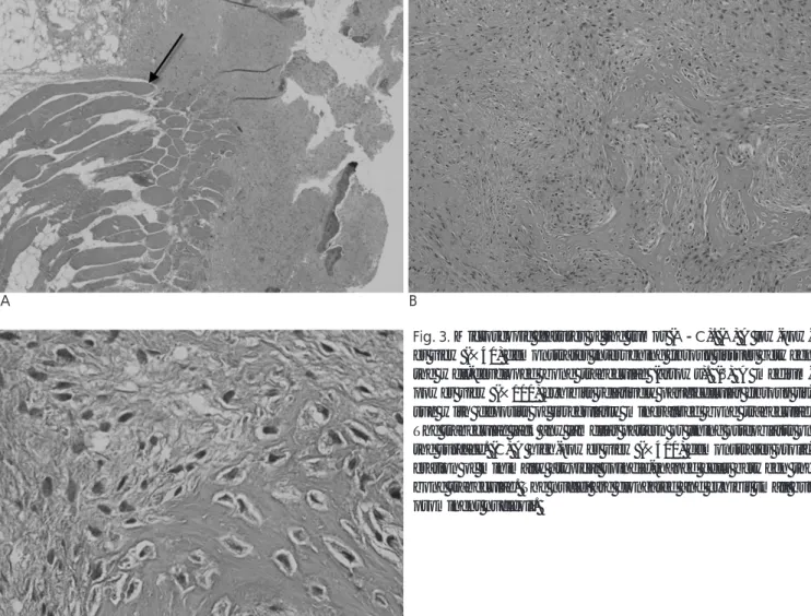 Fig. 3. Microscopic features of the tumor (A- -C). (A) A low-pow- low-pow-er view (×40) demonstrates intlow-pow-ervening fibrous tissues between the well-developed bone trabeculae (arrows)
