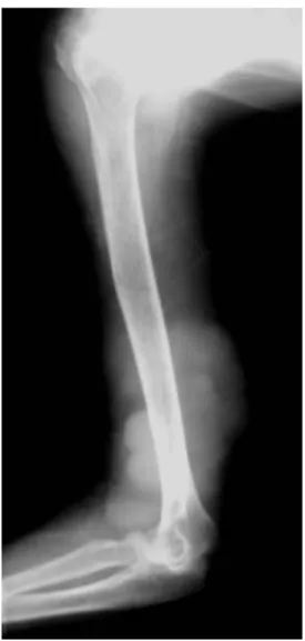 Fig. 3. The axial T1-weighted (A) and fat-suppressed T2-weighted (B) images showed an ill defined mass (arrow) in the subcuta- subcuta-neous tissue of the upper arm