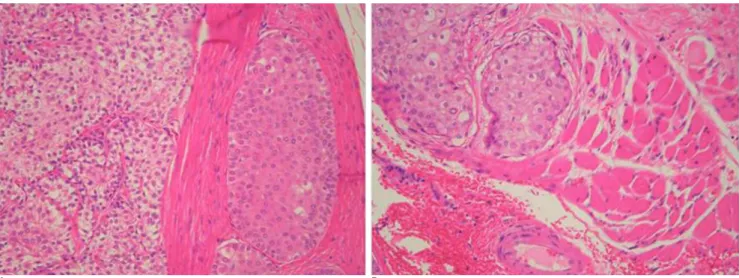 Fig. 5. A. Microscopic examination of the tumor revealed proliferation of two types of cells, basoloid or squamoid cells and clear cells, and they formed a lobular pattern and also solid sheets (hematoxylin and eosin stain, magnification ×200)