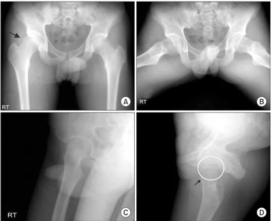 Figure 1. Plain radiographs representing  a mixed type (mainly cam type) FAI with  asphericity