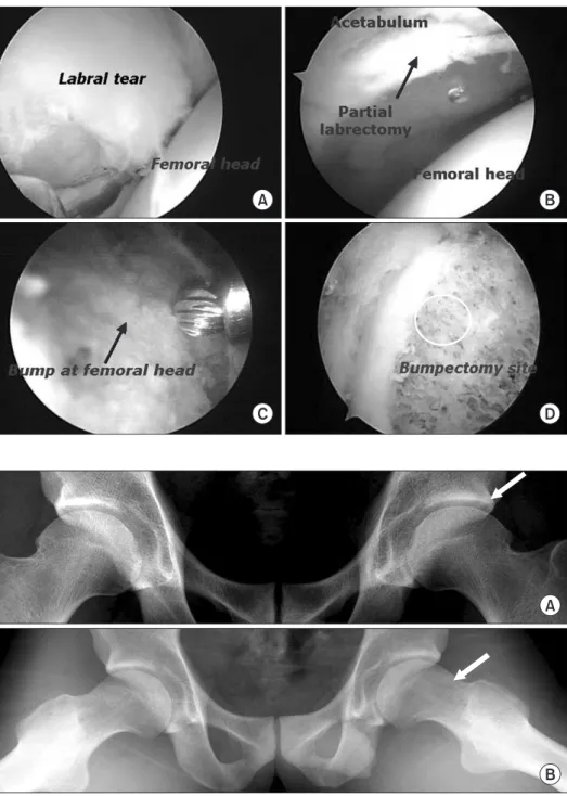 Figure 2. Arthroscopic surgery was per- per-formed. The arethroscopic view (A) shows  labral tear with partial detachment