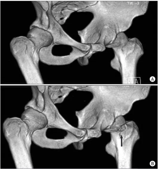 Figure 4. Comparison of preoperative and  postoperative hip CT images. (A) pre  opera-tive CT, (B) postoperaopera-tive CT.