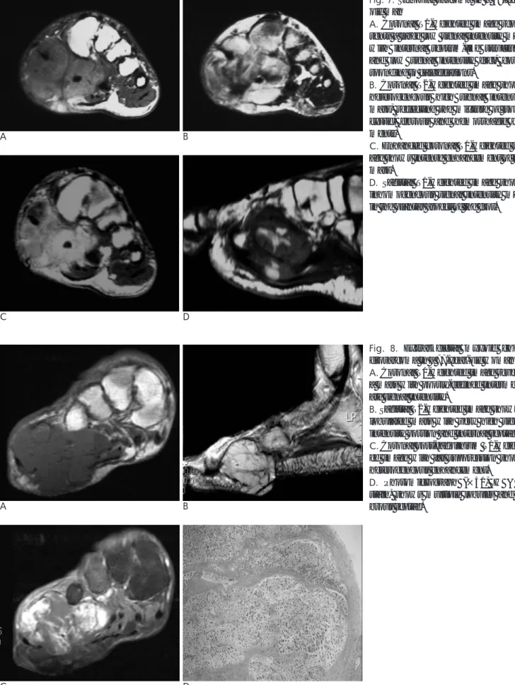 Fig. 8. Extraskeletal myxoid chon- chon-drosarcoma in a 77-year-old woman A. Coronal T1-weighted image reveals a mass with poorly-defined  intermedi-ate signal intensity.
