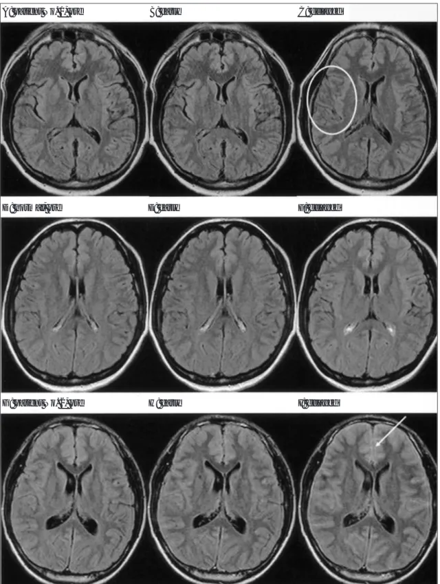 Fig. 8. Pre- and post-enhanced FLAIR images: comparison of the patients and the normal volunteer