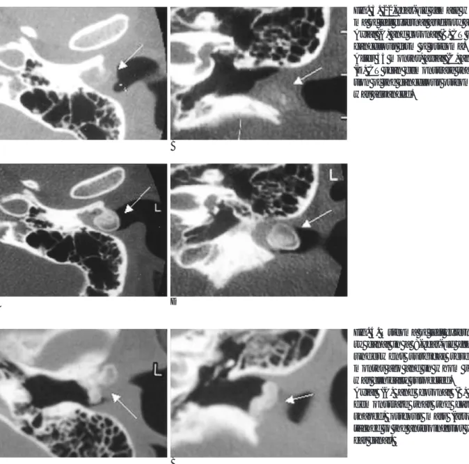 Fig. 3. 22-year-old female with osteo- osteo-ma of left external auditory anal.