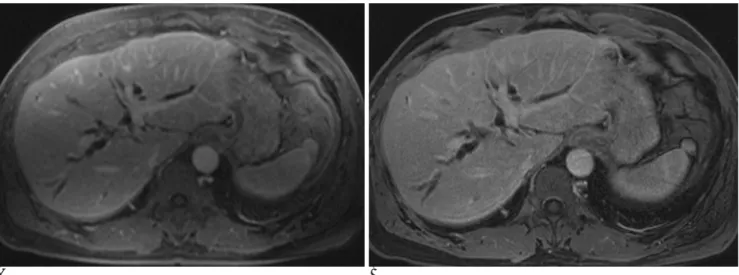 Fig. 2. A 61-year-old man with surgically confirmed common duct cancer.