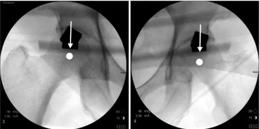 Figure 4. Accuracy of Mechanical Axis  Mar ker was validated using C-arm.  Re-presentative pictures are shown among 20  patients.