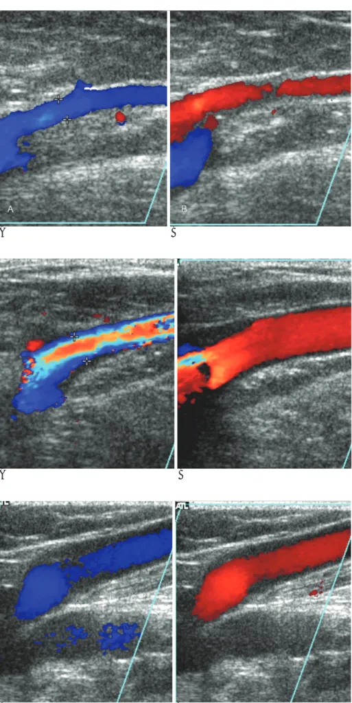 Fig. 1. Grade II reflux : A.  Color Doppler image of great saphenous vein in resting state