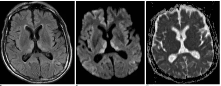 Fig. 20. A 72-year-old man with Wernicke’s encephalopathy. 