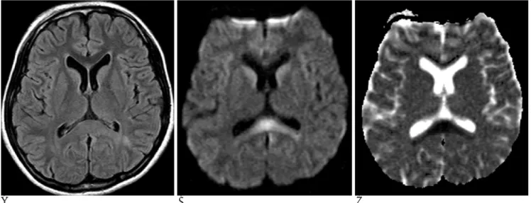 Fig. 7. A 15-year-old female with diffuse axonal injury lesions due to a motor vehicle accident that occurred 10 days previously.