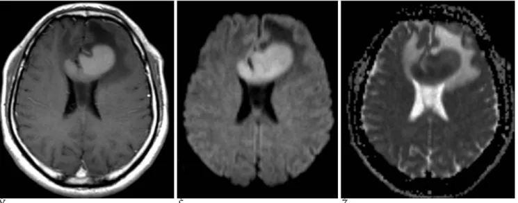 Fig. 10. A 39-year-old man with a malignant lymphoma.