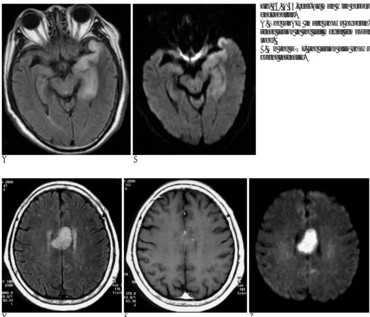 Fig. 16. A 63-year-old man with herpes encephalitis.