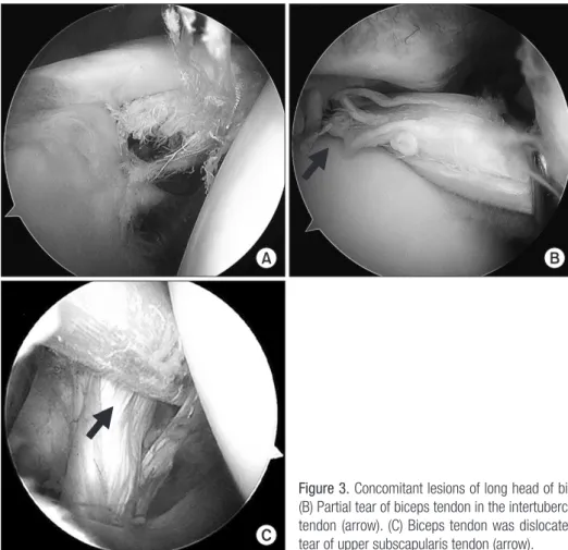 Table 1. Comparison of Range of Motion after Rotator Cuff Repair Preop* Postop †  6 months Last follow up Forward flexion 132.4 o  152 o  (p=0.000) 158.2 o  (p=0.023) External rotation   43.6 o 52.4 o  (p=0.000)   56.8 o  (p=0.070) Internal rotation L3    