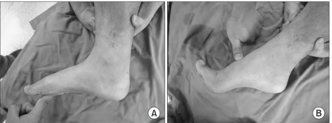 Figure 3. This photograph shows the leng thening of extensor hallucis  longus with looped tendon suture technique.