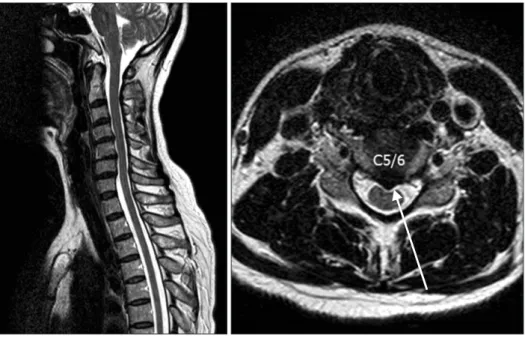Figure 2. Fluoroscopic image during cervical nerve root block.
