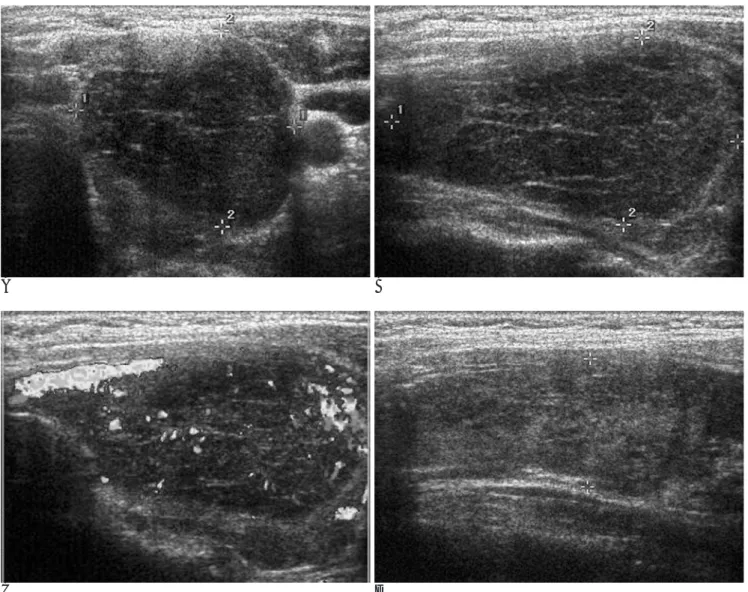 Fig. 1. Transverse (A) and longitudinal (B) gray-scale US demonstrate a large, well demarcated markedly hypoechoic mass with lin- lin-ear strands of increased echogenicity in the left thyroid lobe