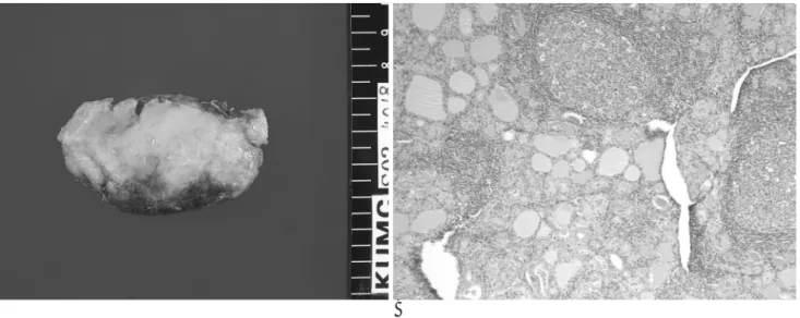 Fig. 4. Grossly (A), the left thyroid lobe measures 7.0×3.5×3.0 cm and it shows a pale-tan to brown, diffusely nodular  appear-ance without a mass lesion