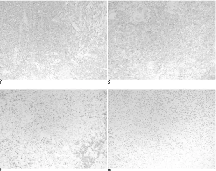 Fig. 5. Immunostaining for CD20 (A) and CD22 (B) shows cytoplasmic staining of the atypical lymphoid cells